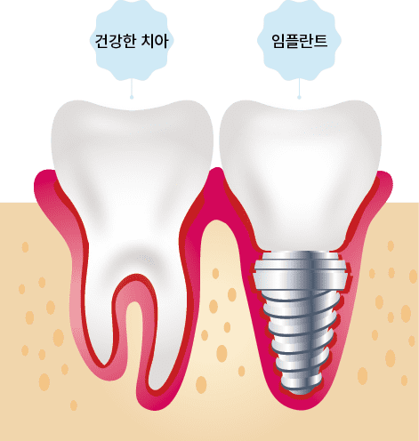 건강한 치아와 임플란트의 비교