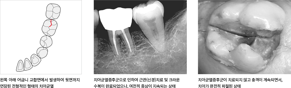 건강한 치아와 임플란트의 비교